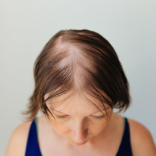 QR678 Hair Treatment for Alopecia Areata