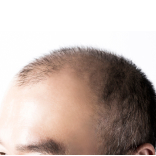 QR678 Hair Treatment for Androgenetic Alopecia