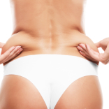 Coolsculpting for Sides