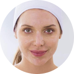 Chemical Peel