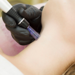 Microneedling with Dermapen for Decolletage
