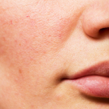 Hydra Facial for Acne Prone Skin