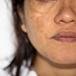 BB Glow Treatment for Hyperpigmentation