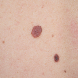 Q Switch for Liver Spots 