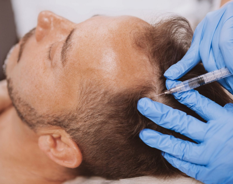 PRP Hair Regrowth Treatment