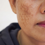 Melasma Treatment