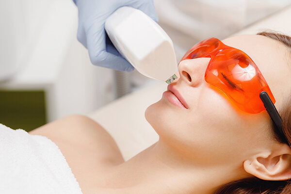 Laser Hair Removal for Face
