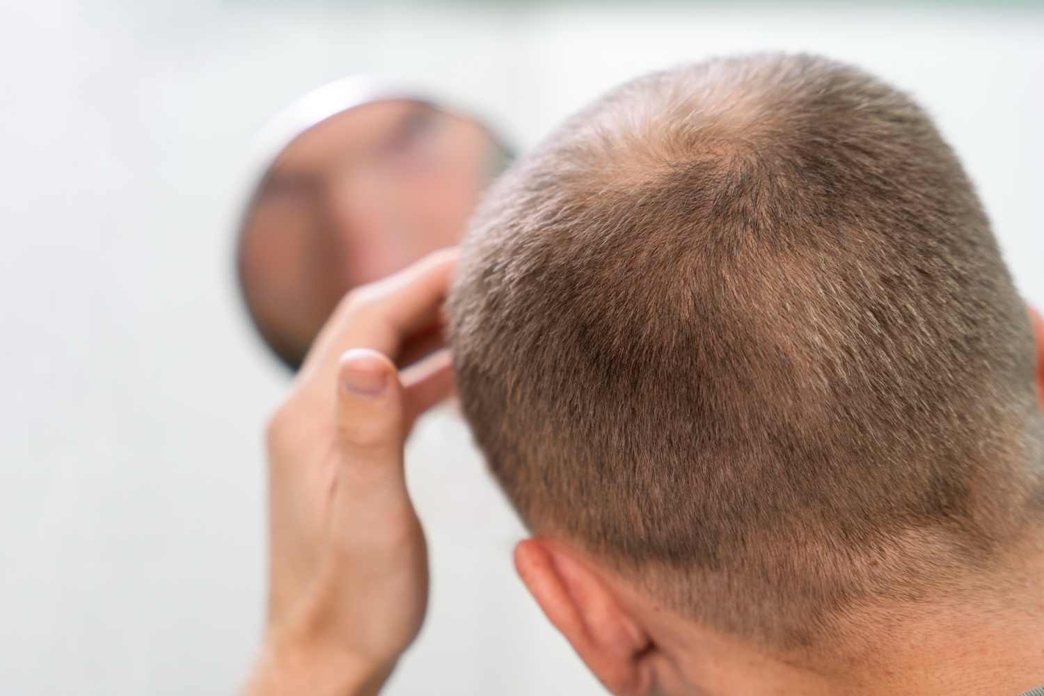 alopecia symptoms