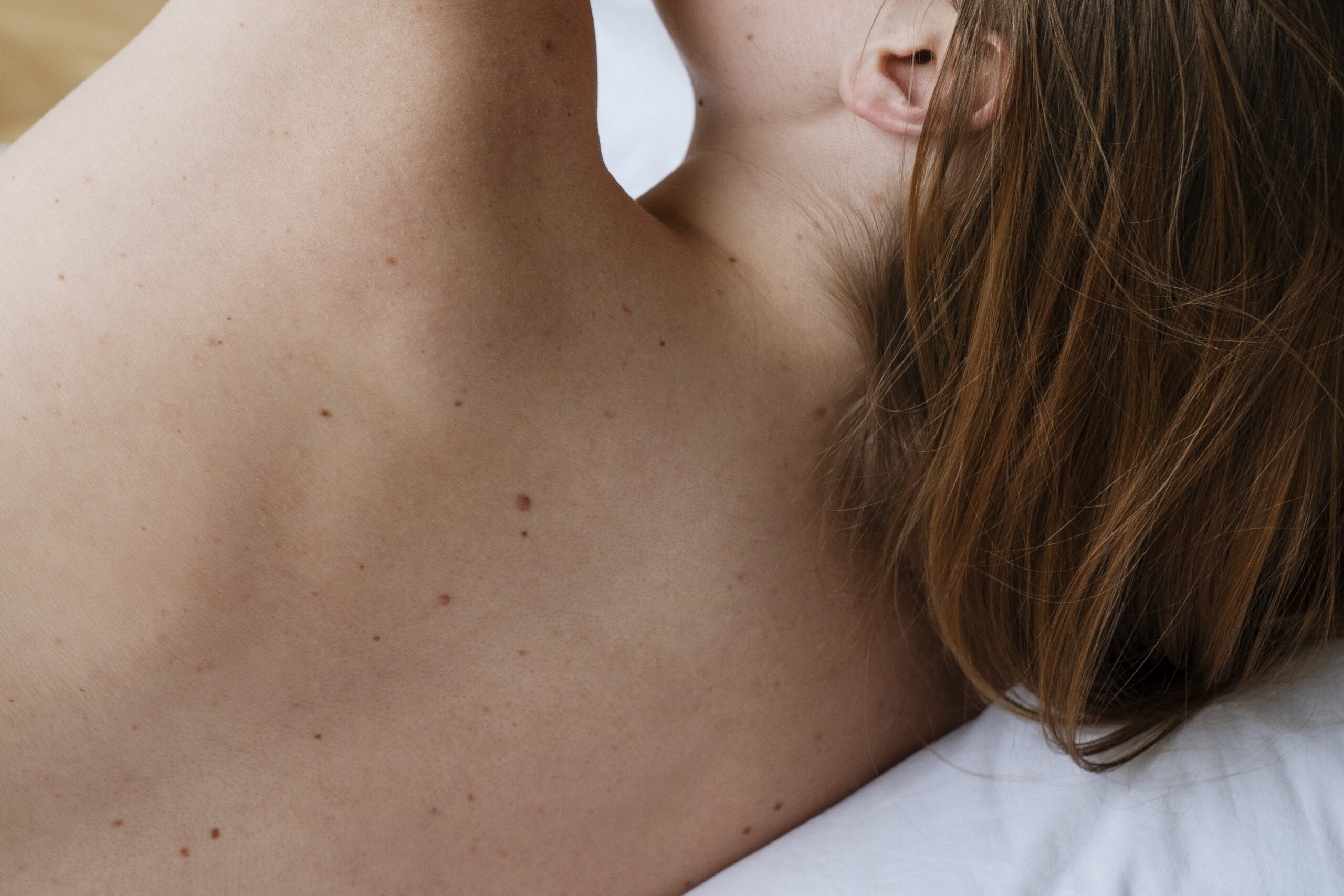 What are the Causes of Back Acne? (Bacne)