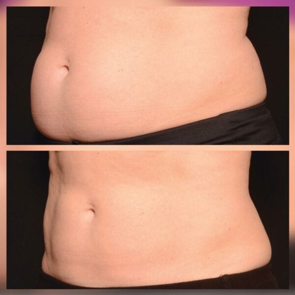 Belly Fat Freezing with CoolSculpting, CoolSculpting Stomach