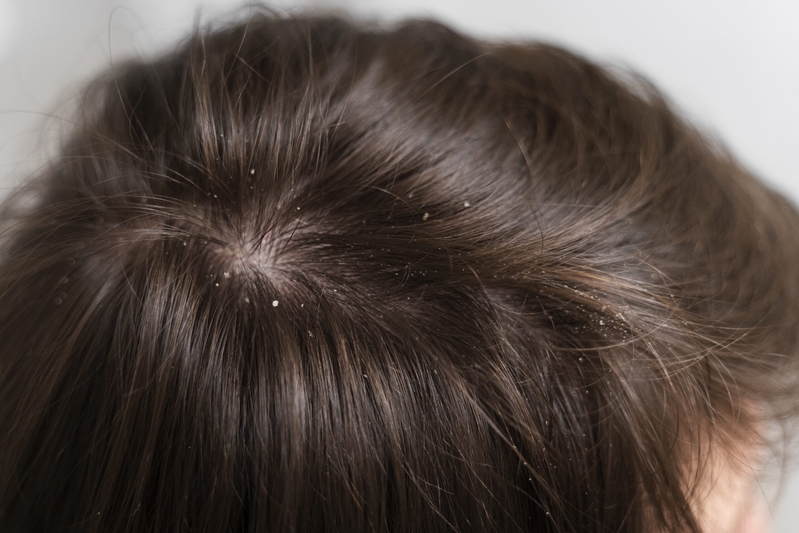 Women Head With Dandruff Caused By The Problem Of Dirty. Or Caused By Skin  Disease Or Seborrheic Dermatitis. It Has White Scaly And It Will Cause  Itch. Stock Photo, Picture and Royalty