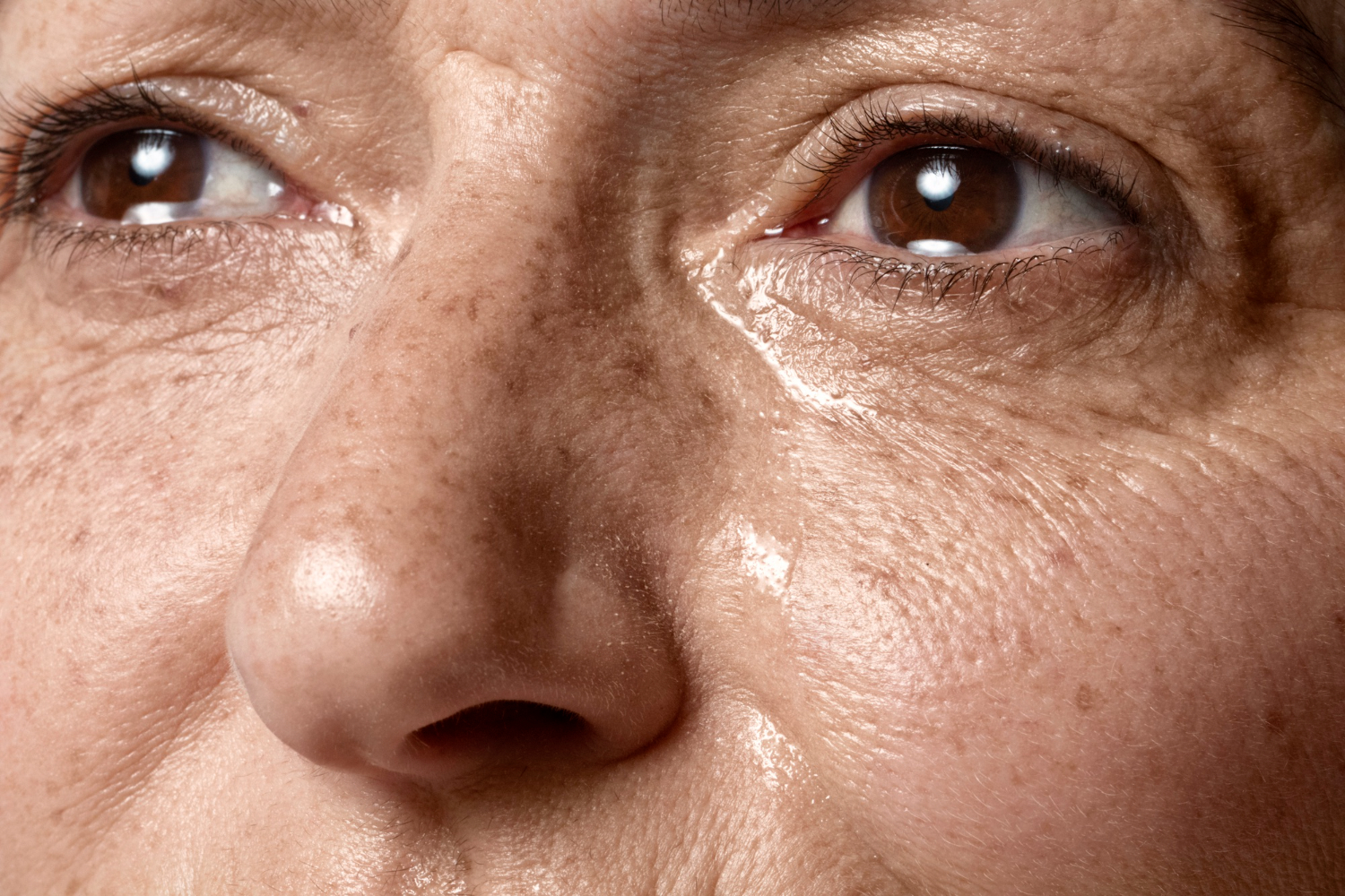 What is Melasma 