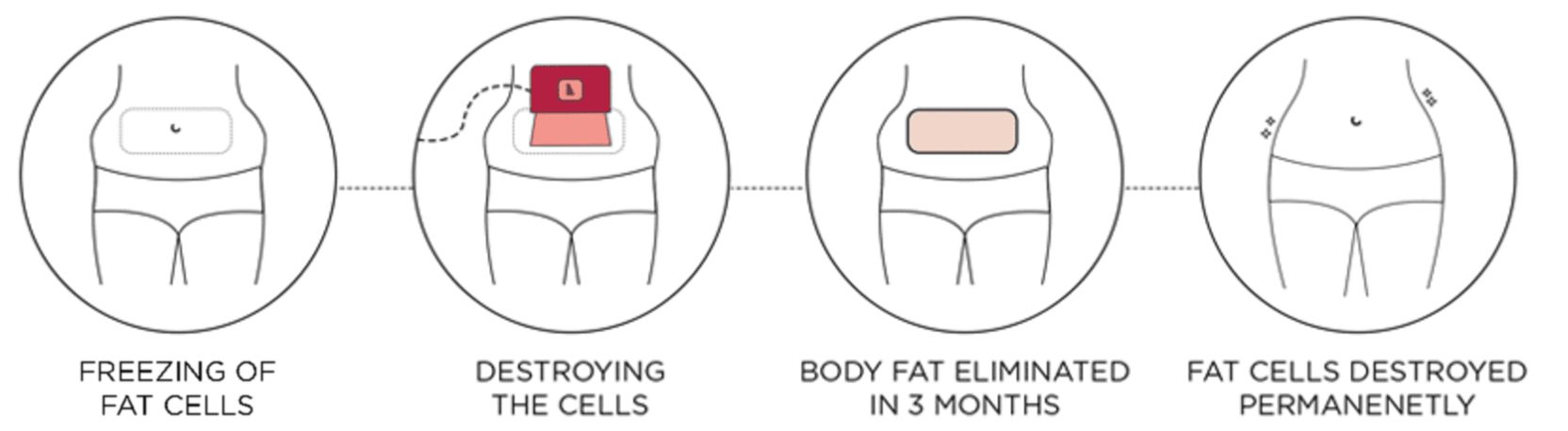 Coolsculpting Treatment  Process