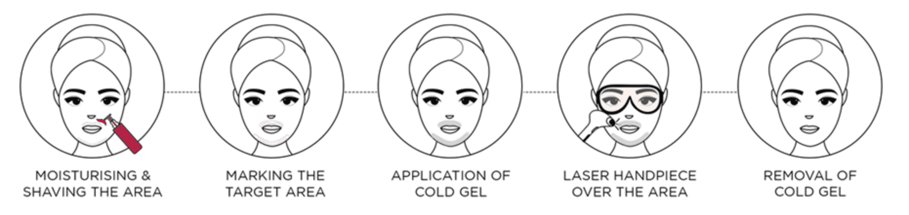 laser-hair-reduction-process