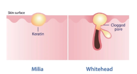 Difference between milia and whiteheads