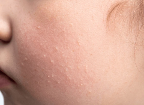 Causes for milia