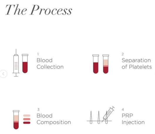 GFC Treatment for Hair loss Procedure