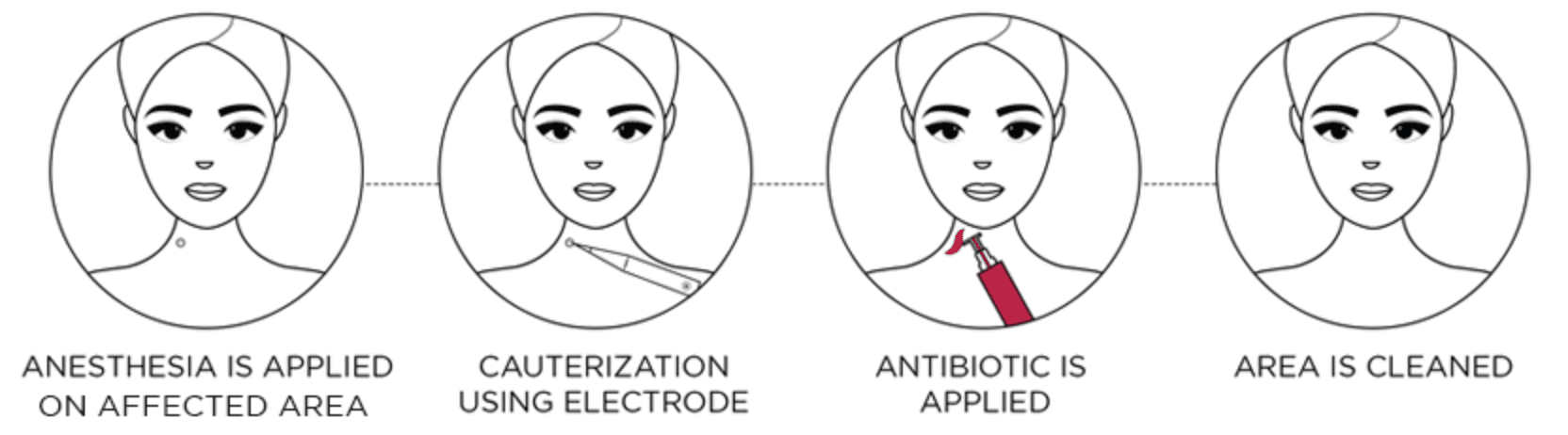 radio-frequency-surgery-process