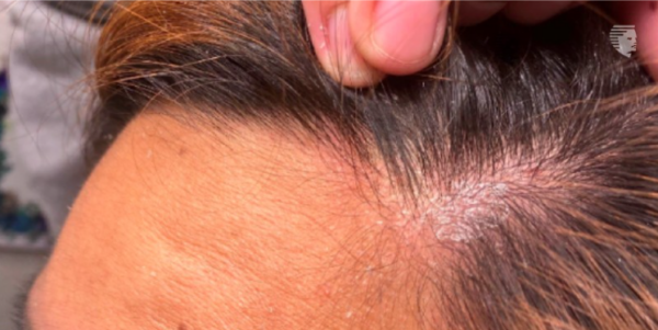 Scalp infection treatments