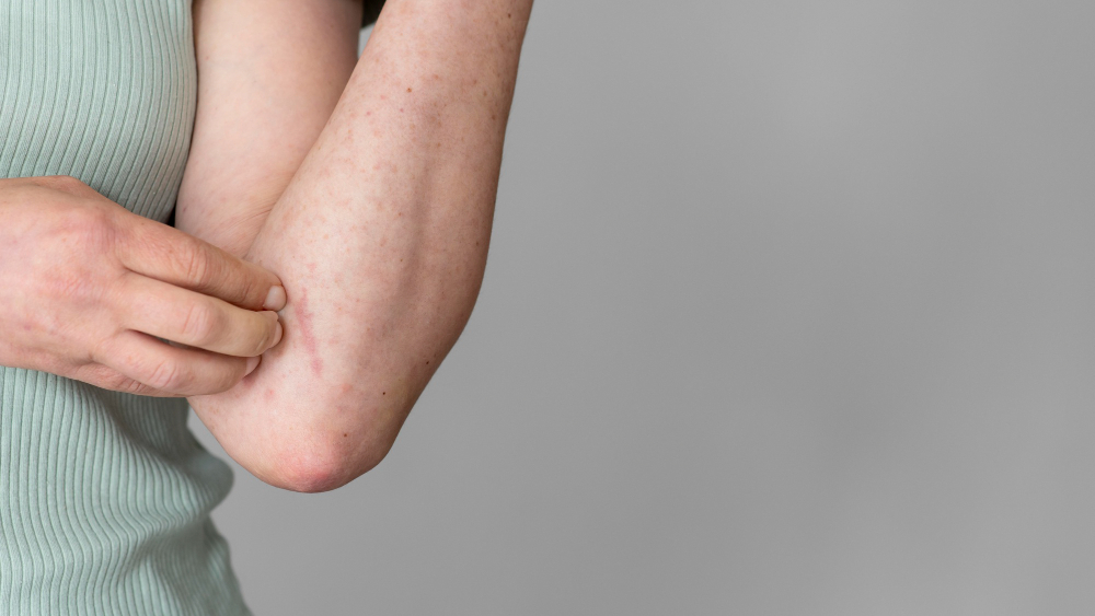 how to remove chicken pox marks