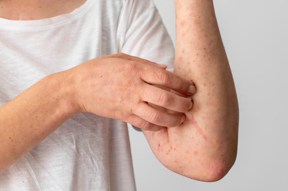 how to remove chicken pox marks